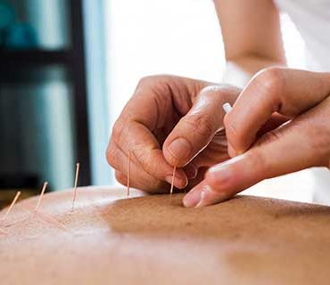Acupuncture teaser