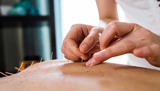 Acupuncture teaser